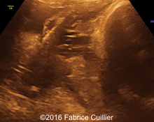 Vasa previa with bilobate placenta image