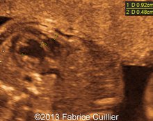 Aortic valve stenosis, endocardial fibroelastosis, 23 weeks image