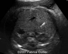 Prenatal diagnosis of fetal gallstones image