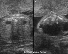 Cloacal dysgenesis with imperforated anus image