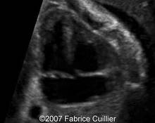 Trisomy 21, ventricular septal defect image