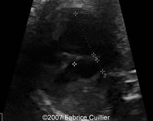 Tricuspid insufficiency and right atrioventricular hypertrophy with pulmonary atresia image