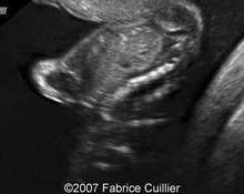 Iniencephaly and acrania image