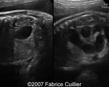Duodenal and proximal jejunal atresia, 31 weeks image