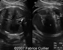 Cystic fibrosis and meconium ileus image