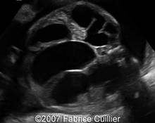 Congenital megaurethra, 28 weeks image