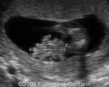 Gastroschisis, two cases image
