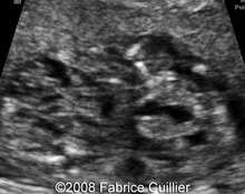 Multicystic dysplastic kidney disease, bilateral, 17 weeks image