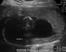 Monosomy X affecting one of the fetuses of dichorionic twin pregnancy image