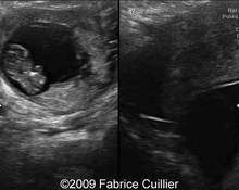 Limb-body wall complex in ectopic pregnancy image