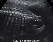 Sacrococcygeal teratoma, 26 weeks image