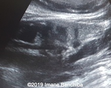 Esophageal atresia image
