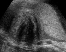 Retroplacental fibroid image