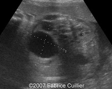 Unilateral multicystic dysplastic kidney image
