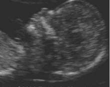 First trimester examination image