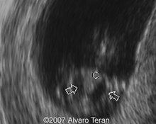 Trisomy 21, transient bilateral pleural effusion image