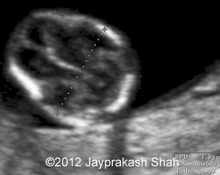Omphalocele, monosomy 15 image