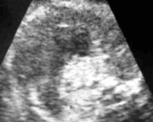 Lung sequestration, extralobar subdiaphragmatic image
