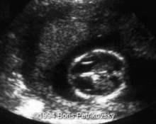 Fetal needle injuries during diagnostic amniocentesis image