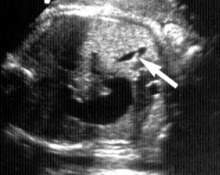 Gallbladder, septation image