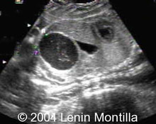 Abdominal cyst, transient image