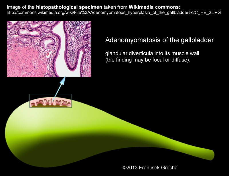 Adenomyomatosis_gallbladder_FG_drawing