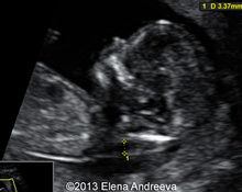 Diaphragmatic hernia, 1st trimester image