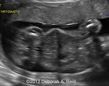 Congenital diaphragmatic hernia image