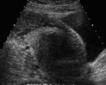 Uterine myoma and pregnancy image