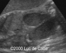 Cloacal dysgenesis with imperforated anus and didelphus uterus image