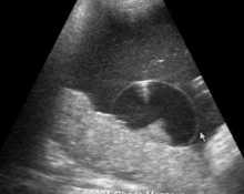 Placental cysts image