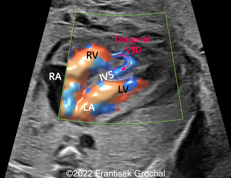 4-chamber-view showing diagonal defect within the interventricular septum which makes kind of “dissection” of its walls. LA - left atrium, LV - left ventricle, RA - right atrium, RV - right ventricle, IVS – interventricular septum.
