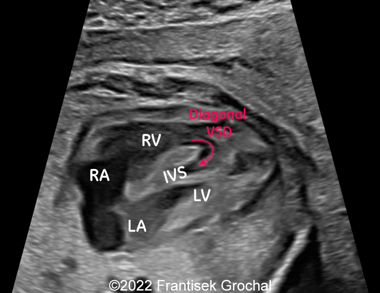 4-chamber-view showing diagonal defect within the interventricular septum which makes kind of “dissection” of its walls. LA - left atrium, LV - left ventricle, RA - right atrium, RV - right ventricle, IVS – interventricular septum.
