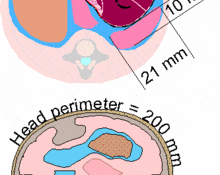 Diaphragmatic hernia image