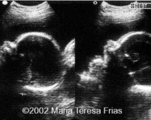 Trisomy 21, 29 weeks image