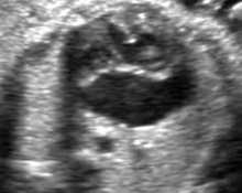 Double-outlet right ventricle with subpulmonary stenosis in association with a complete atrioventricular canal defect image