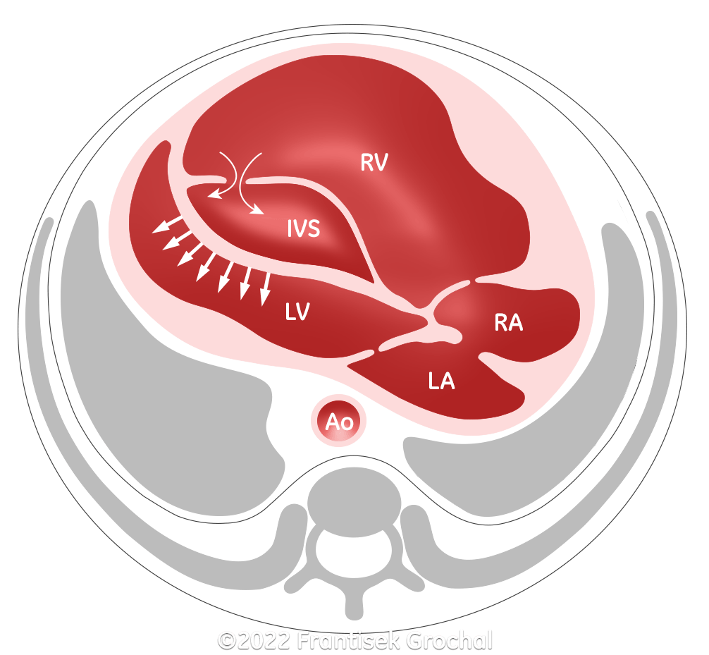 As blood accumulates in the interventricular septum, the left septal wall bulges into the left ventricular cavity. (RV–right ventricle; LV–left ventricle; IVS–interventricular septum; RA–right atrium; LA–left atrium; Ao–aorta)