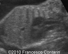 Esophageal atresia with Trisomy 18 image