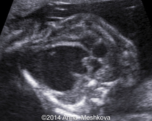 Aneurysm, left ventricle image