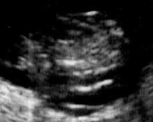 Umbilical cord, short umbilical cord syndrome image