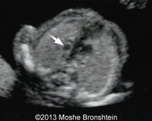 DiGeorge syndrome - new sonographic markers: pedal edema and persistent left superior vena cava image