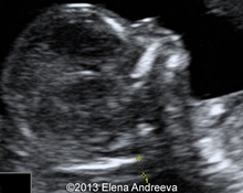 Trisomy 21, 14 weeks image