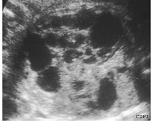 Multicystic dysplastic kidney image