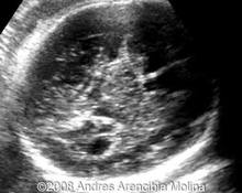Congenital hypothalamic hamartoma syndrome image