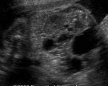 Horseshoe kidney with unilateral multicystic dysplasia image