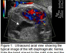 Magnetic Resonance in the fetus Diaphragmatic hernia image