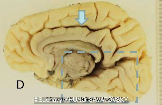 Inner right view showing an usual cingulate sulcus (arrow).