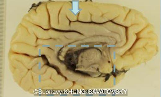 Inner left view showing an unusual interrupted cingulate sulcus (arrow).