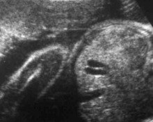 Gallbladder, duplication image