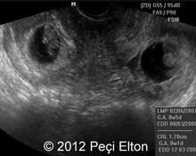 Heterotopic Pregnancy image